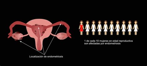 prevalencia de la endometriosis